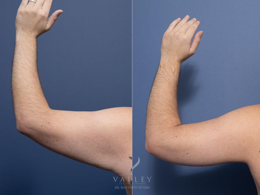 Bilateral Brachioplasty (arm lift) Surgery, Dr Matthew Peters, VPS Brisbane