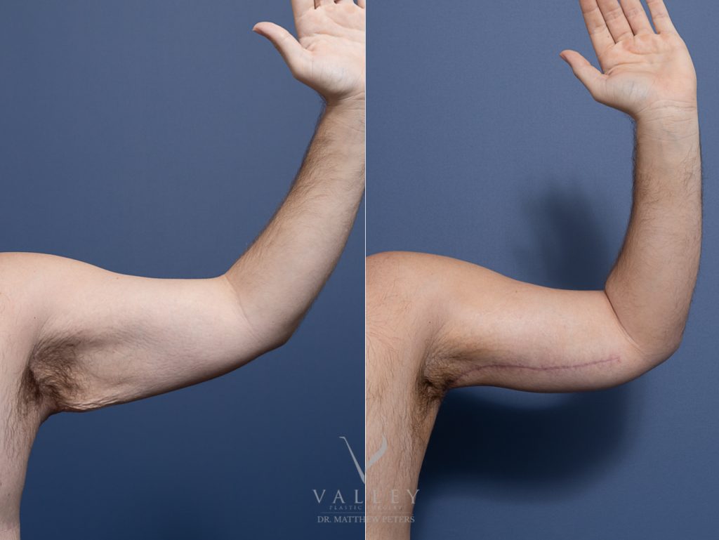 Bilateral Brachioplasty Surgery with Dr Matthew Peters, before and afters
