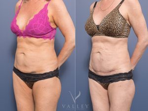 Lower abdomen scar revision Dr Chris Jardim