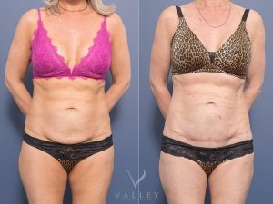 Lower abdomen scar revision Dr Chris Jardim