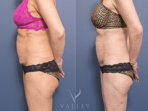 Lower abdomen scar revision Dr Chris Jardim