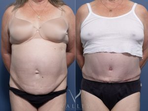 Abdominoplasty with liposuction Dr Raymond Goh