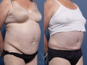 Abdominoplasty with liposuction Dr Raymond Goh