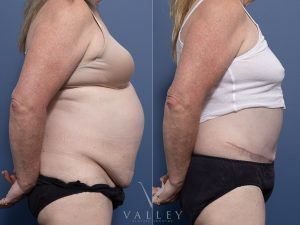 Abdominoplasty with liposuction Dr Raymond Goh