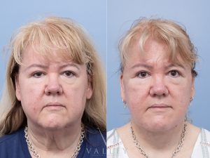 Deep plane face and neck lift Dr Adam Honeybrook