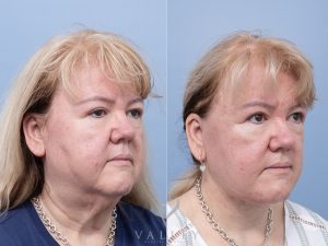 Deep plane face and neck lift Dr Adam Honeybrook