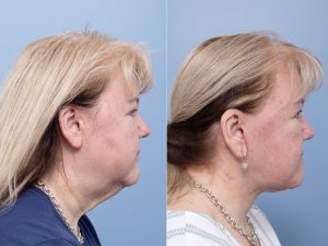 Deep plane face and neck lift Dr Adam Honeybrook