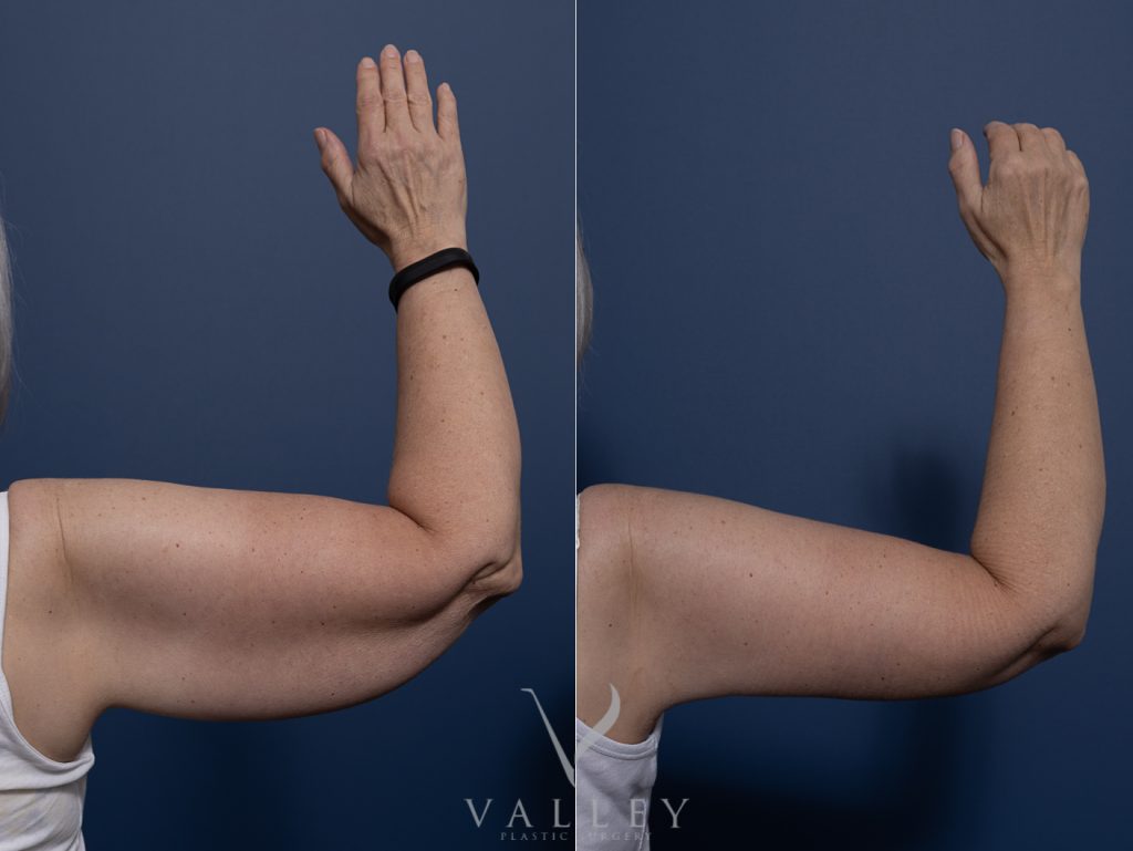 Brachioplasty Dr Chris Jardim