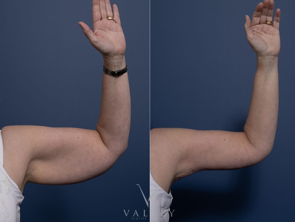 Brachioplasty Dr Chris Jardim