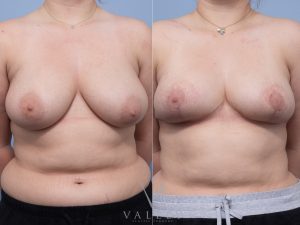 Bilateral Breast Reduction Dr Matthew Cheng