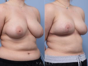 Bilateral Breast Reduction Dr Matthew Cheng