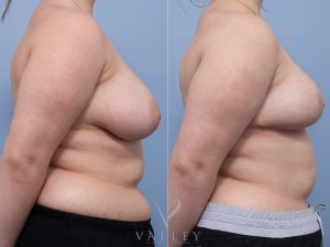 Bilateral Breast Reduction Dr Matthew Cheng