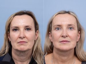 Deep plane face and neck lift Dr Adam Honeybrook