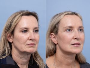 Deep plane face and neck lift Dr Adam Honeybrook
