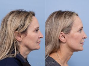 Deep plane face and neck lift Dr Adam Honeybrook