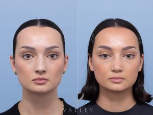 Septorhinoplasty Dr Adam Honeybrook