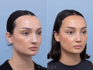 Septorhinoplasty Dr Adam Honeybrook