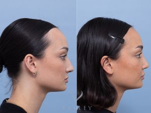 Septorhinoplasty Dr Adam Honeybrook