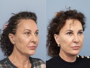 Face and neck lift, upper and lower blepharoplasty with canthoplasty Dr Adam Honeybrook