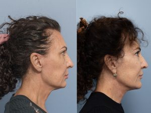 Face and neck lift, upper and lower blepharoplasty with canthoplasty Dr Adam Honeybrook