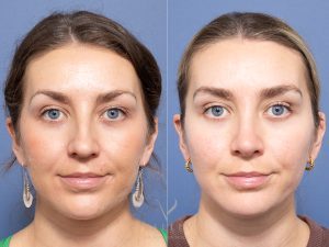 Rhinoplasty Dr Raymond Goh