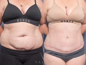 Abdominoplasty Dr Raymond Goh