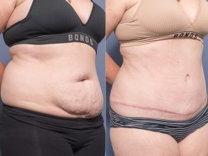 Abdominoplasty Dr Raymond Goh