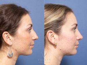 Rhinoplasty Dr Raymond Goh