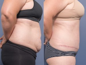 Abdominoplasty Dr Raymond Goh
