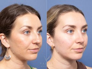 Rhinoplasty Dr Raymond Goh