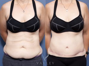 Abdominoplasty with lipectomy Dr Raymond Goh