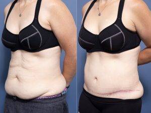 Abdominoplasty with lipectomy Dr Raymond Goh
