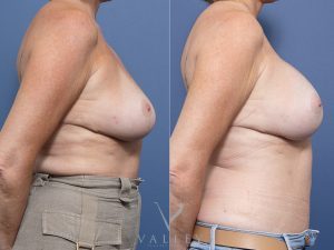 Breast Augmentation - 290CC Dr Raymond Goh