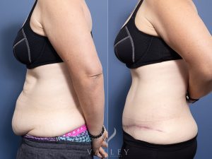 Abdominoplasty with lipectomy Dr Raymond Goh