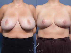 Bilateral Breast Reduction Dr Raymond Goh