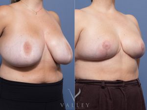 Bilateral Breast Reduction Dr Raymond Goh