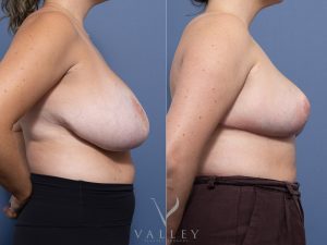 Bilateral Breast Reduction Dr Raymond Goh