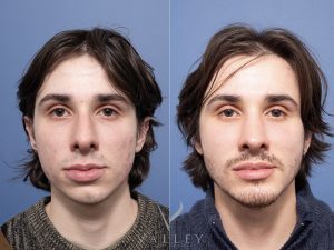 Rhinoplasty and Genioplasty Dr Raymond Goh