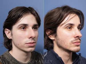 Rhinoplasty and Genioplasty Dr Raymond Goh