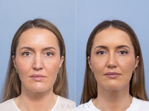 Septorhinoplasty Dr Adam Honeybrook