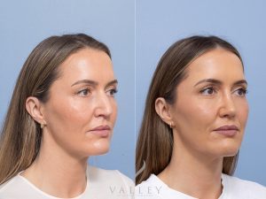 Septorhinoplasty with inferior turbinate reduction and donor rib allograft Dr Adam Honeybrook