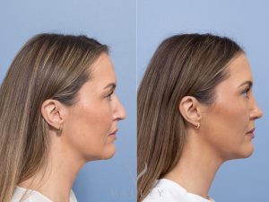 Septorhinoplasty with inferior turbinate reduction and donor rib allograft Dr Adam Honeybrook