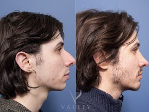 Rhinoplasty and Genioplasty Dr Raymond Goh