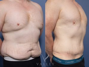 Abdominoplasty and Gynecomastia surgery Dr Chris Jardim