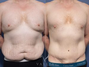 Abdominoplasty and Gynecomastia surgery Dr Chris Jardim