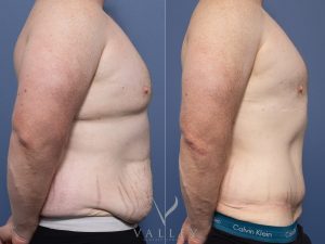 Abdominoplasty and Gynecomastia surgery Dr Chris Jardim
