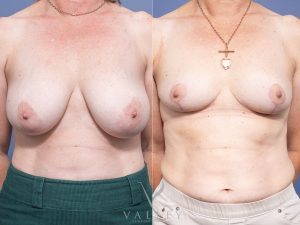 Bilateral Breast Reduction Dr Raymond Goh