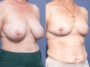 Bilateral Breast Reduction Dr Raymond Goh