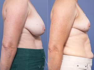 Bilateral Breast Reduction Dr Raymond Goh