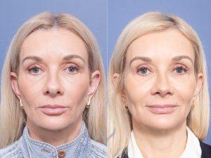 Rhinoplasty Dr Raymond Goh